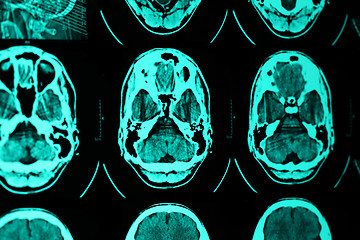 Image showing CT and MRI of the skull