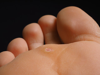 Image showing Closeup of foot with a infected wart placed under toes, isolated