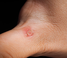 Image showing Closeup of injury on hand below thumb isolated towards black bac