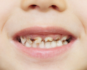 Image showing bad teeth
