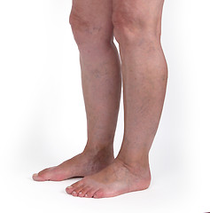 Image showing Old woman with varicose veins