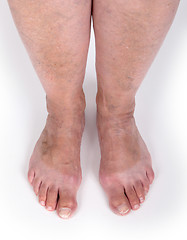 Image showing Old woman with varicose veins