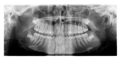 Image showing Dental X-Ray