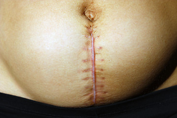 Image showing seams after the operation of Caesarian section