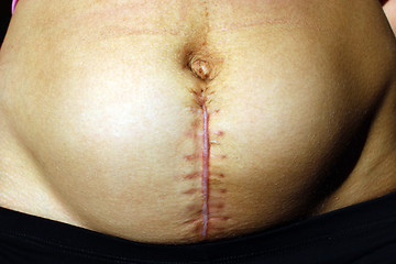 Image showing seams after the operation of Caesarian section