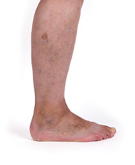 Image showing Old woman with varicose veins