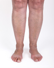 Image showing Old woman with varicose veins