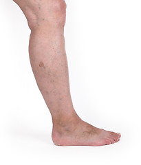 Image showing Old woman with varicose veins