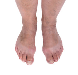 Image showing Old woman with varicose veins