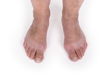 Image showing Old woman with varicose veins