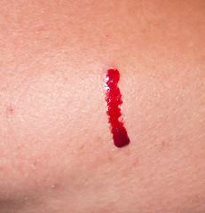 Image showing bleeding