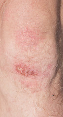 Image showing wound