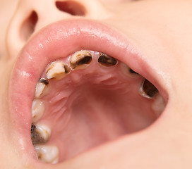 Image showing caries