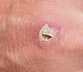 Image showing wound