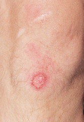 Image showing wound