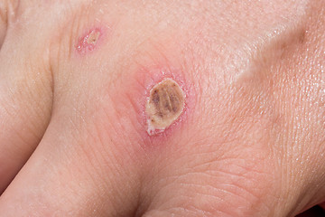 Image showing wound