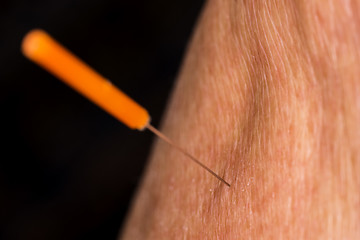 Image showing acupuncture treatment on leg