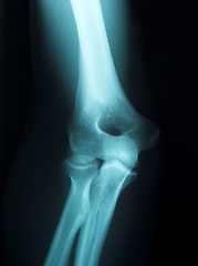 Image showing x-ray of a male arm
