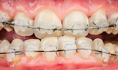 Image showing Braces