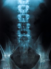 Image showing x-ray of a young male spine