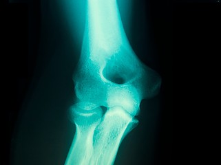 Image showing x-ray of a male arm joint