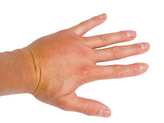 Image showing Male person showing swollen knuckles on left hand isolated on wh