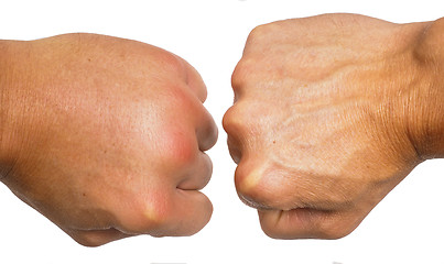 Image showing Comparing swollen male hands isolated towards white background