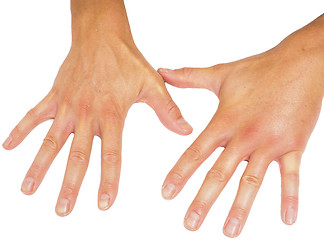 Image showing Comparing swollen male hands isolated towards white background