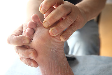 Image showing Foot with dry, peeling skin