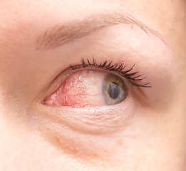 Image showing irritated eye