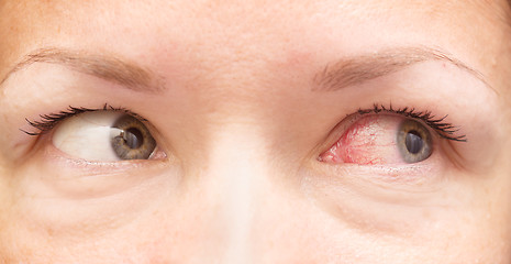 Image showing healthy and irritated eye
