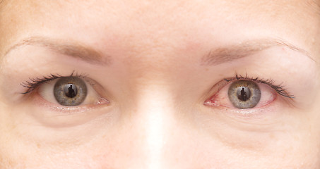 Image showing healthy and irritated eye