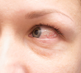 Image showing irritated eye