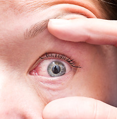 Image showing irritated eye