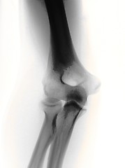 Image showing x-ray of a elbow