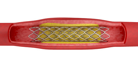 Image showing Angioplasty with stent placement