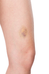 Image showing Woman nursing an injured bruised grazed knee 