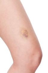 Image showing Bruised knee