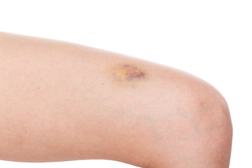 Image showing Woman leg with pain and a large bruise