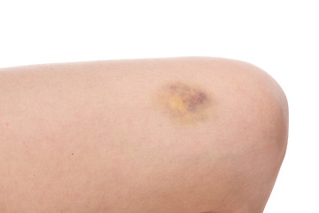 Image showing Bruise on wounded woman leg skin