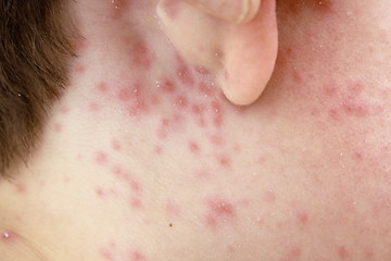 Image showing detail of chicken pox effects