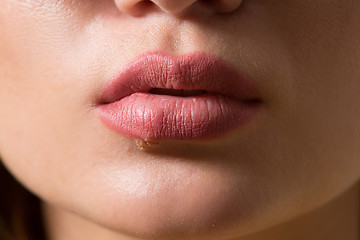 Image showing beautiful lips virus infected herpes