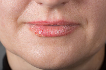 Image showing Lip infection with the herpes virus