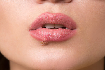 Image showing beautiful lips virus infected herpes