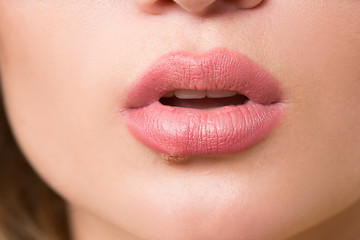 Image showing beautiful lips virus infected herpes