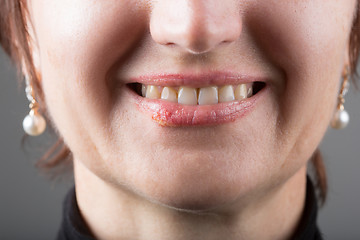 Image showing Lip infection with the herpes virus