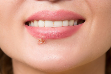 Image showing beautiful lips virus infected herpes