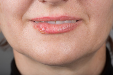 Image showing Lip infection with the herpes virus