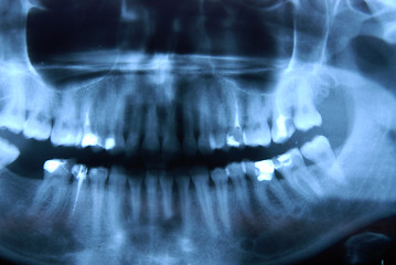 Image showing roentgen - jaw, nandible