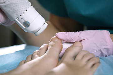 Image showing Podiatrist treating onychomycosis with a laser